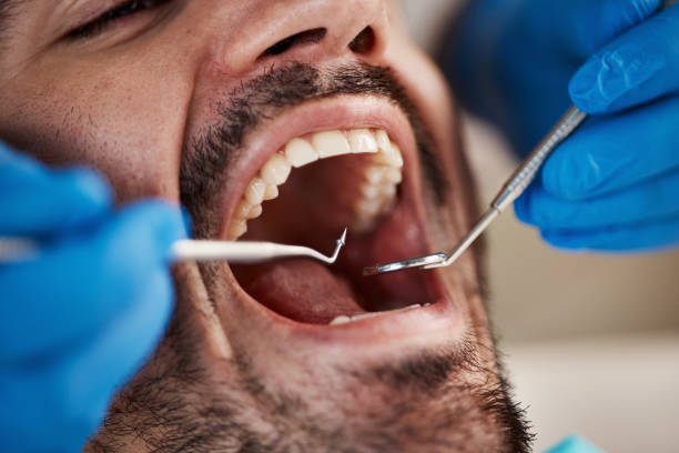 Best Wisdom Tooth Removal  in Vernon, AL